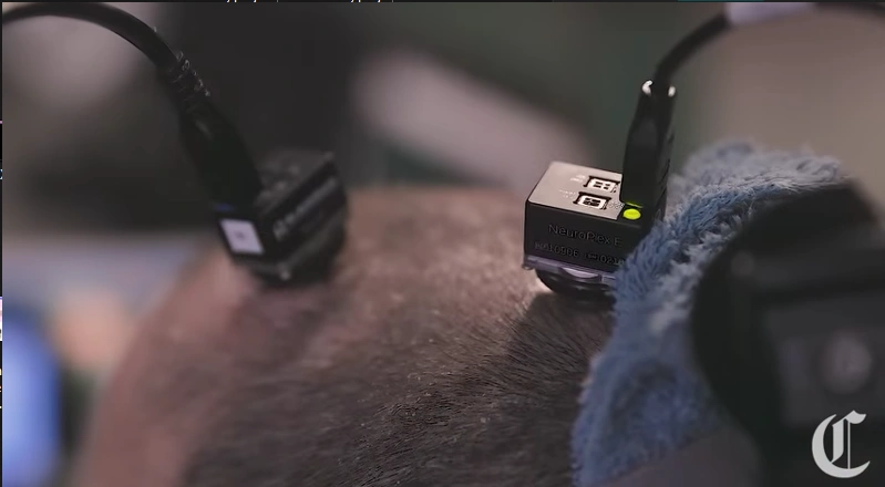 imagem da cabeça de um homem com dois fios pretos conectados ao chip implantado no celebro em outro angulo